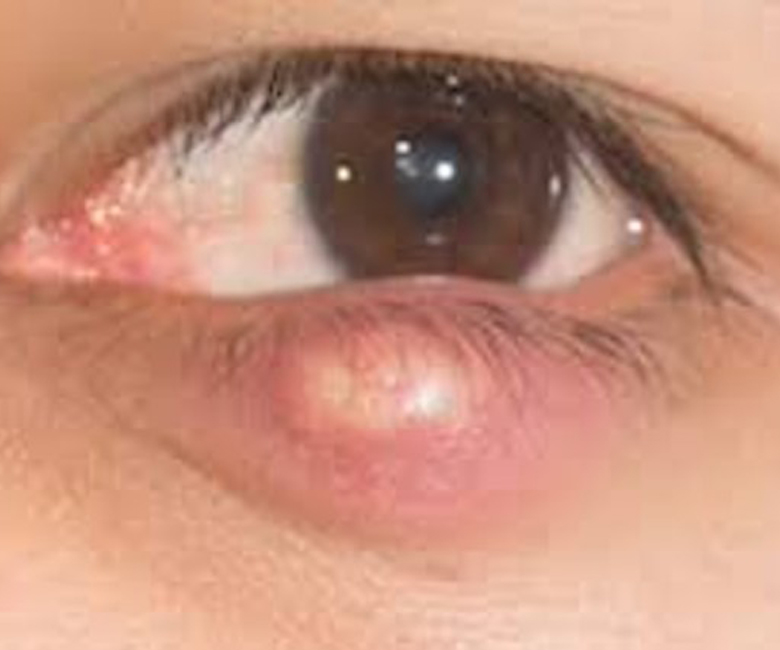 diplopia la copii